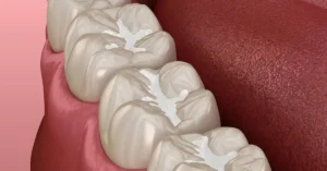 Perbedaan Penting Tambal Gigi Sementara vs Permanen: Mana yang Lebih Efektif?