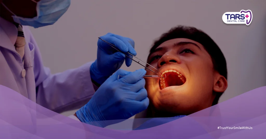 Pemulihan Cabut Gigi Bungsu vs Biasa: Mana yang Lebih Cepat?