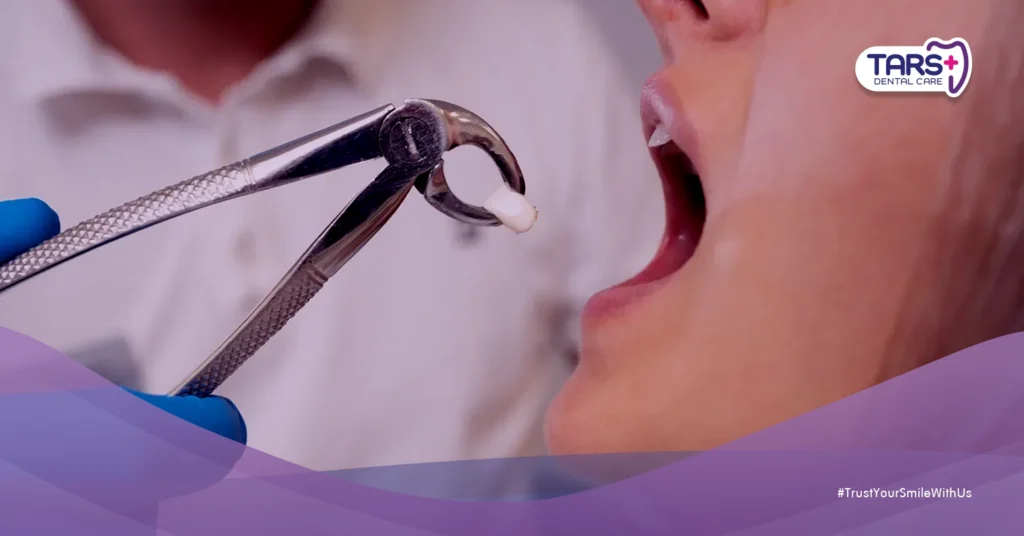 Apa yang Terjadi Jika Gigi Bungsu Tidak Dicabut? Risiko Kesehatan yang Mungkin Terjadi