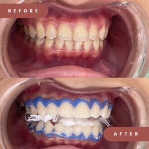 Ingin Gigi Putih Permanen? Ini Kelebihan & Kekurangan Bleaching dan Veneer