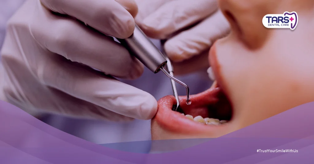 Bedanya Cabut Gigi Bungsu dan Cabut Gigi Biasa: Prosedur dan Pemulihan