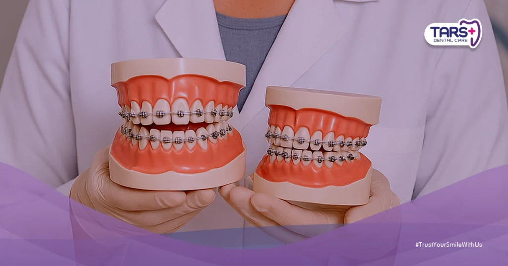 Jenis Behel yang Cocok untuk Gaya Hidup dan Budget Kamu