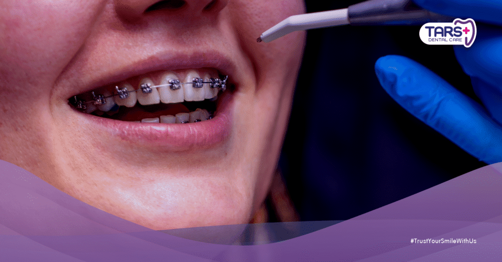 Behel Terbaik untuk Dewasa dan Remaja Jenis, Harga, dan Prosesnya