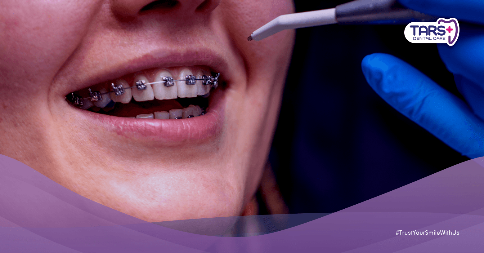 Behel Terbaik untuk Dewasa dan Remaja Jenis, Harga, dan Prosesnya