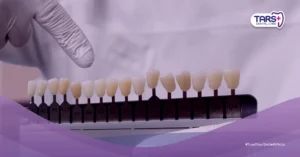 Bleaching dan Veneer: Biaya, Prosedur, Keunggulan, Kekurangan, dan Perawatan Setelahnya