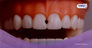 Direct Veneer vs Tambal Gigi Depan: Temukan Jawaban Terbaik untuk Senyum Percaya Diri Anda