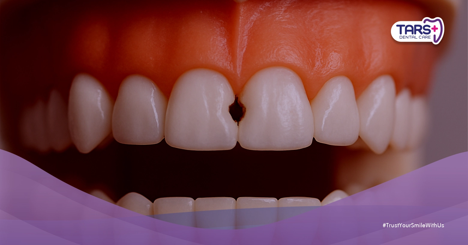 Direct Veneer vs Tambal Gigi Depan: Temukan Jawaban Terbaik untuk Senyum Percaya Diri Anda