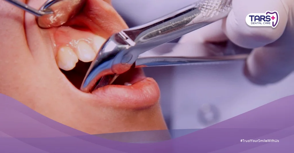 Cabut Gigi Biasa vs Gigi Bungsu: Ini Bedanya dari Biaya sampai Perawatannya