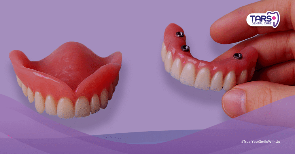 Gigi Palsu Lepasan dan Cekat: Biaya, Prosedur, Keunggulan, Kekurangan, dan Perawatannya