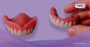 4 Manfaat Gigi Tiruan untuk Kesehatan Gigi Palsu Lepasan dan Cekat: Biaya, Prosedur, Keunggulan, Kekurangan, dan Perawatannya
