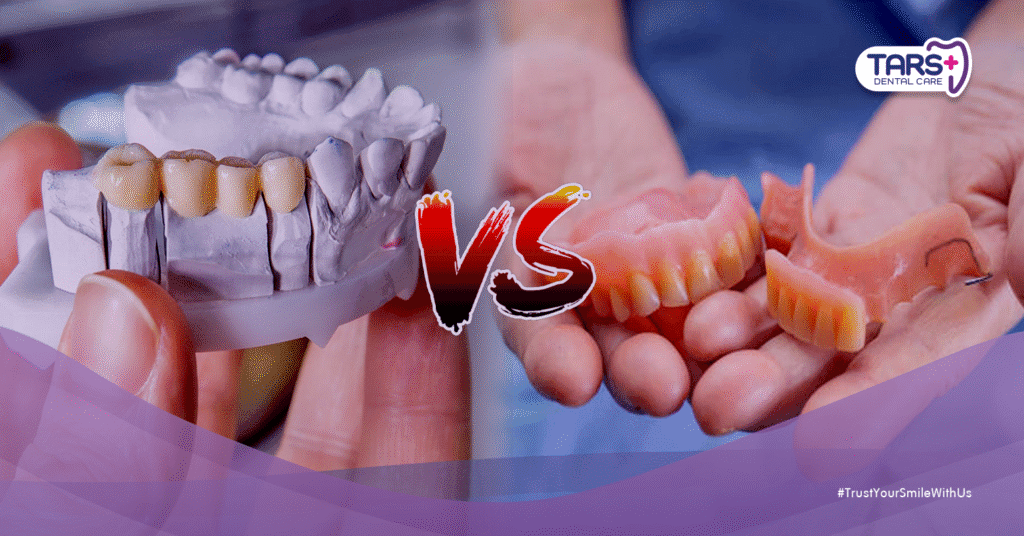 Gigi Palsu Lepasan vs Gigi Palsu Cekat: Mana yang Lebih Cocok untuk Anda?