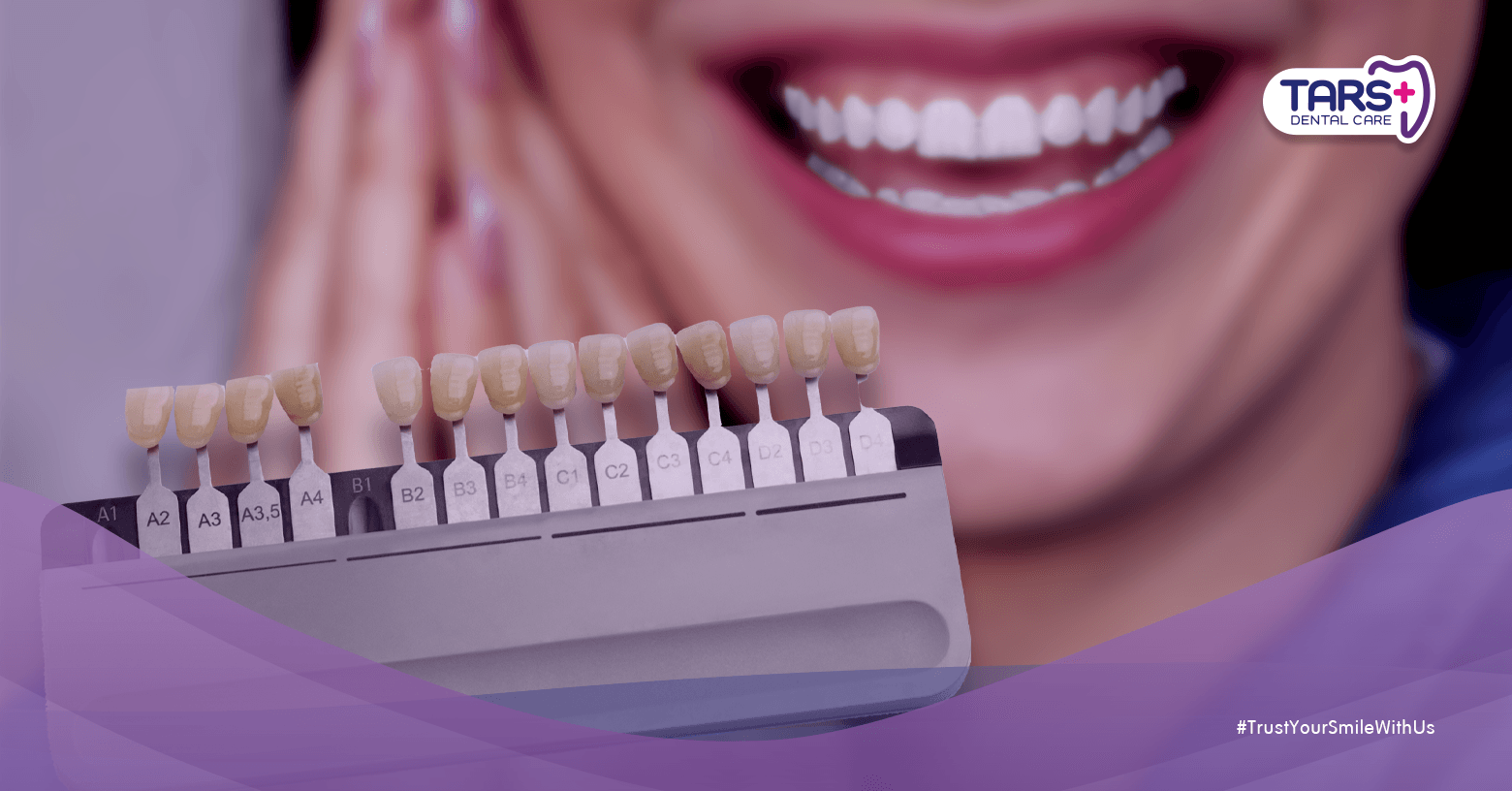 Bleaching Gigi vs Veneer: 7 Hal Penting yang Harus Kamu Tahu Sebelum Memilih