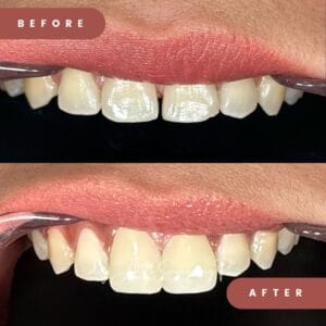 Ingin Gigi Putih Permanen? Ini Kelebihan & Kekurangan Bleaching dan Veneer