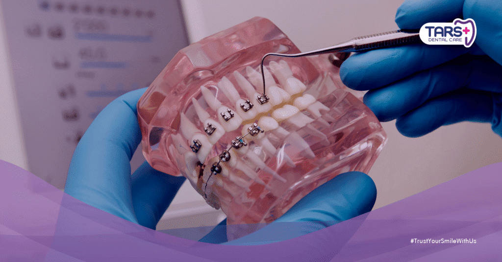 Jenis Behel: Biaya, Prosedur, Keunggulan dan Kekurangan Masing-Masing Tipe