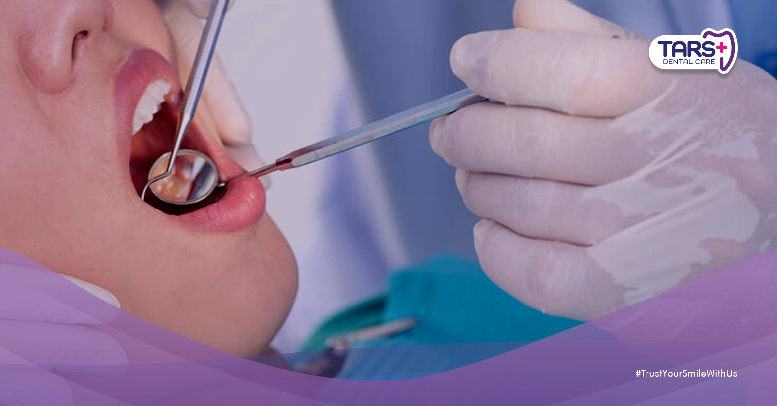 Rahasia Memilih Direct Veneer atau Tambal Gigi Depan: Jangan Sampai Salah Pilih!