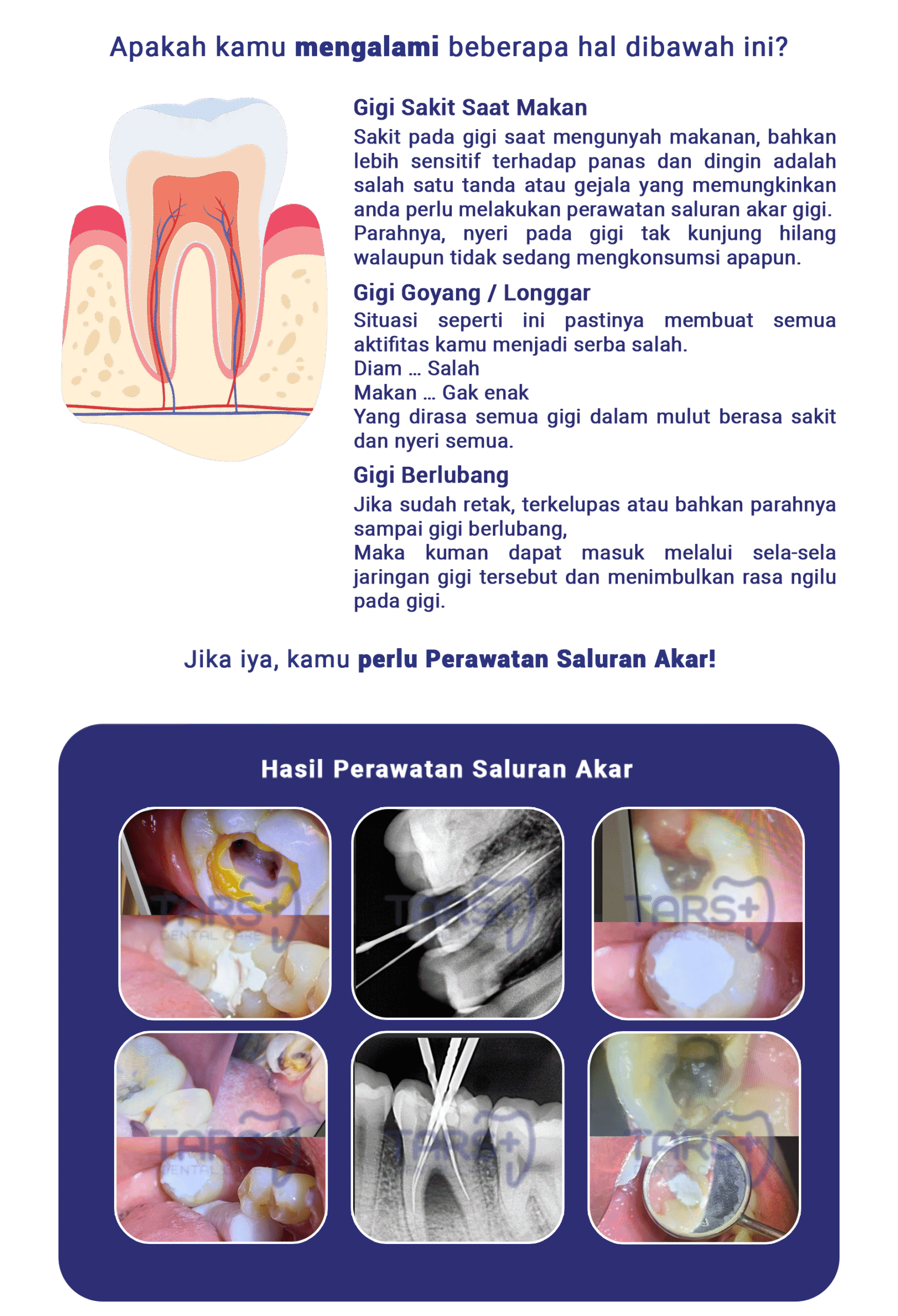 Perawatan Saluran Akar - LP 2024