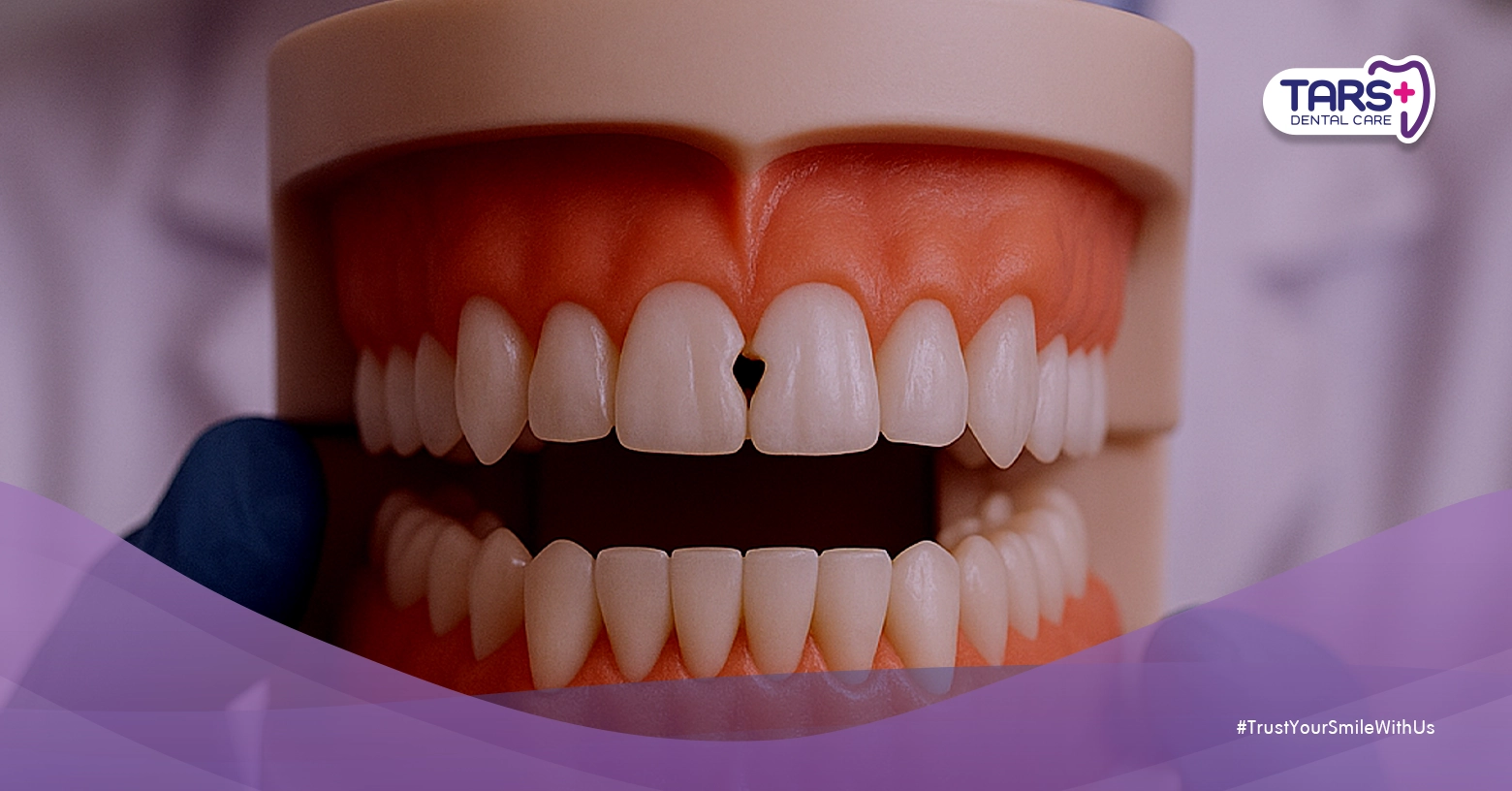 Membedakan Direct Veneer dan Tambal Gigi Depan: Prosedur, Harga, dan Hasil Akhir