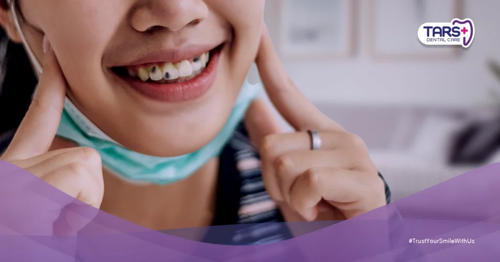 Mengapa Noda Hitam di Gigi Bukan Selalu Karang Gigi?