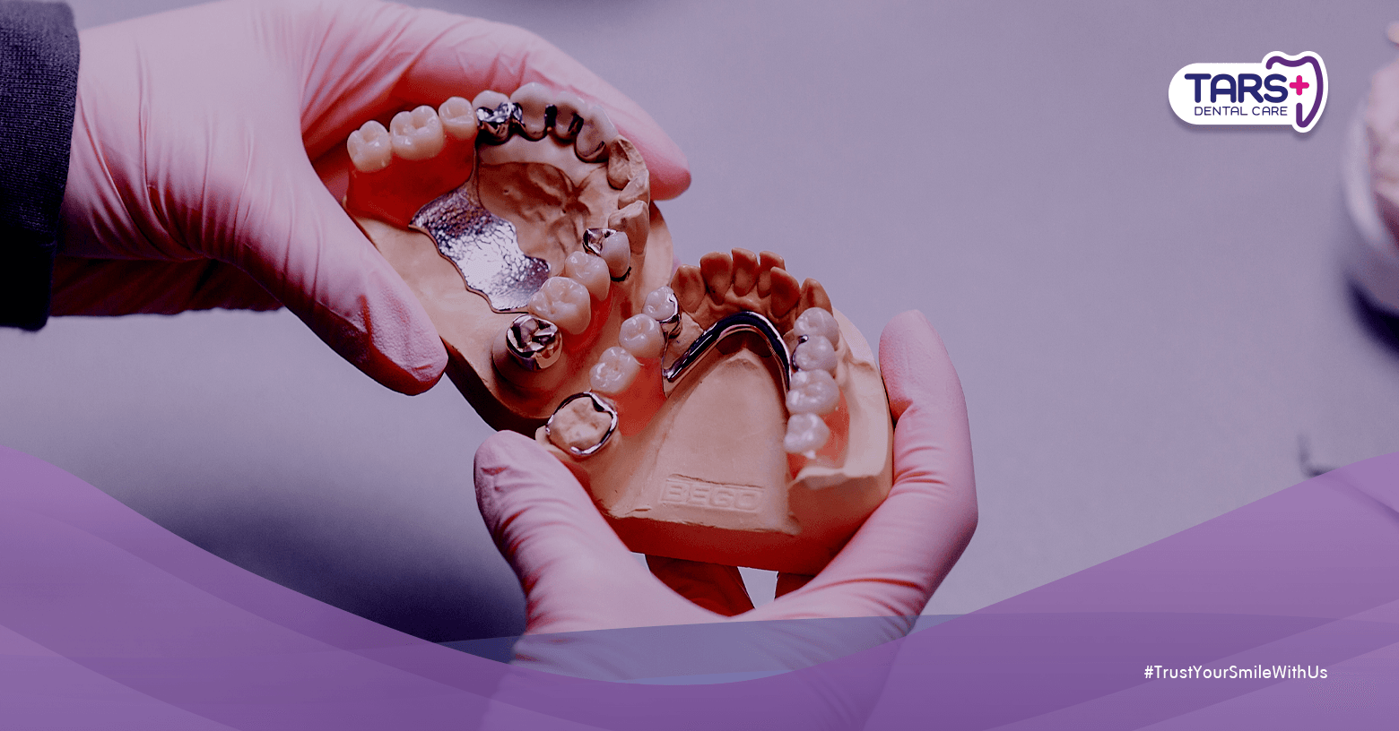 Perawatan Gigi Palsu Lepasan dan Cekat Agar Tahan Lama