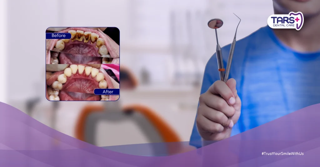 Solusi Tepat untuk Mengatasi Stain dan Karang Gigi Secara Efektif