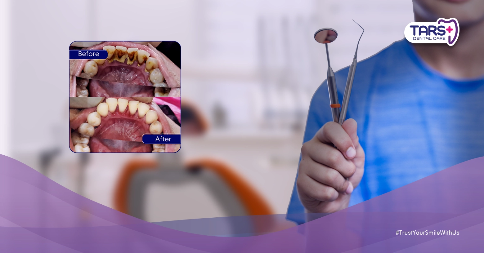 Solusi Tepat untuk Mengatasi Stain dan Karang Gigi Secara Efektif