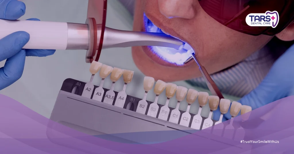 7 Alasan Memilih Veneer atau Bleaching – Mana Prosedur Gigi Terbaik untuk Senyum Cerahmu?