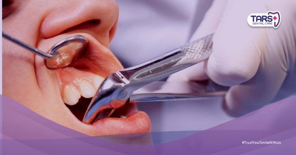 Odontektomi: Cabut Gigi Bungsu yang Katanya Menakutkan, Benarkah?