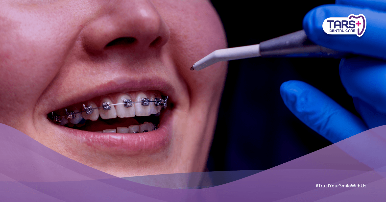 Banyak yang Ketipu Promo Behel Murah, Ini Kata Dokter Gigi