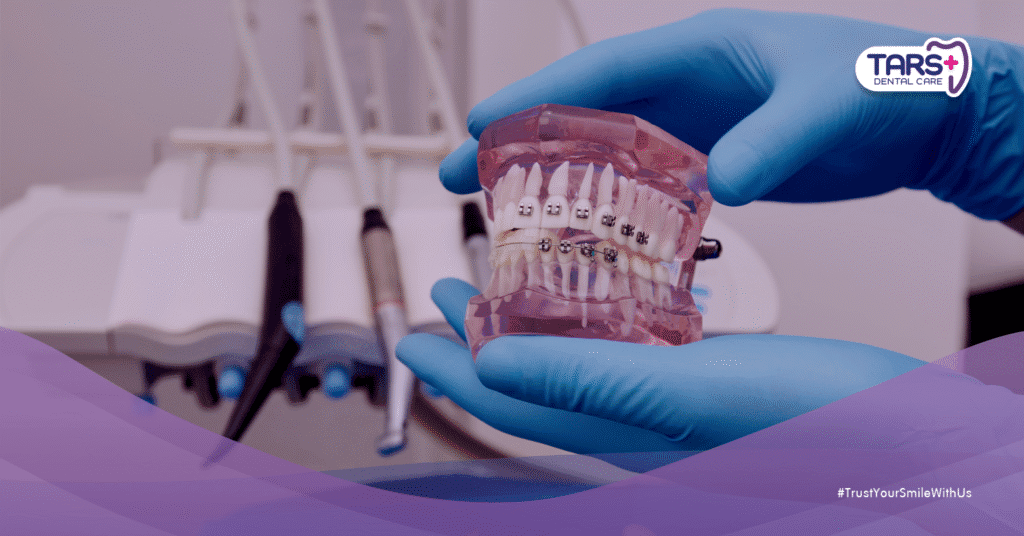 5 Fakta Penting Perbedaan Behel Gigi 3 Juta vs 10 Juta yang Wajib Kamu Tahu!