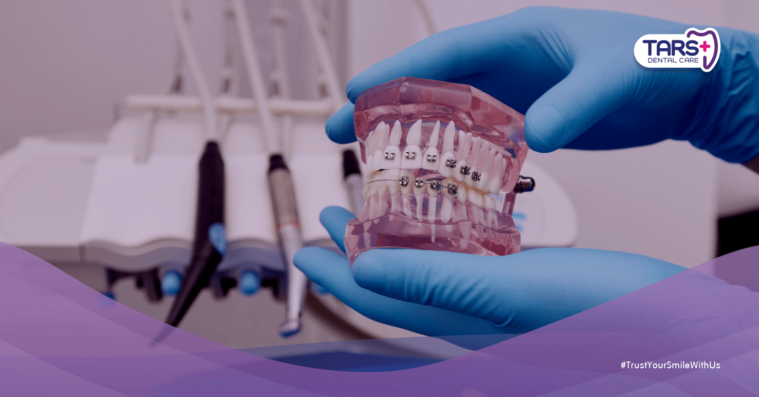 5 Fakta Penting Perbedaan Behel Gigi 3 Juta vs 10 Juta yang Wajib Kamu Tahu!