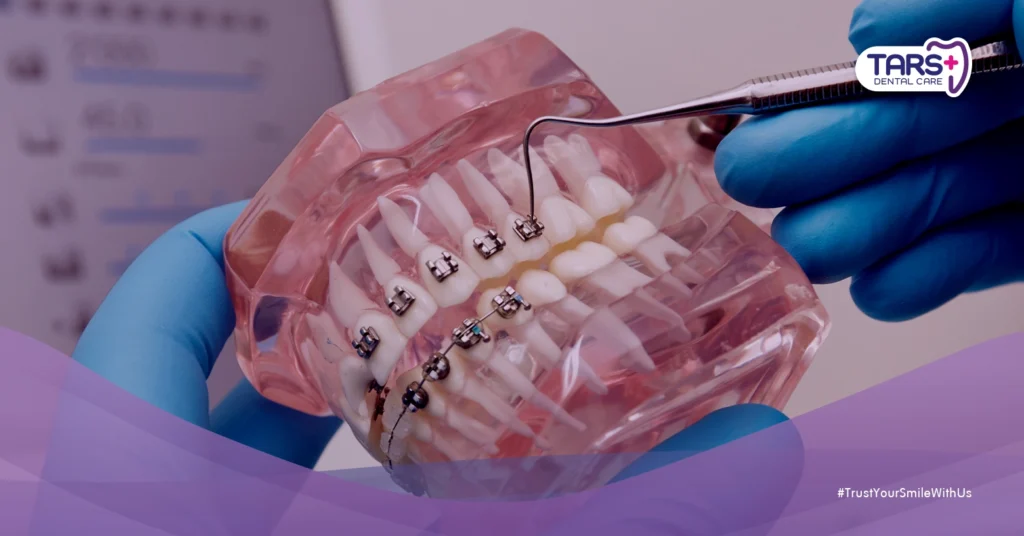 Pasang Behel Gigi? Ini 7 Manfaat yang Jarang Diketahui Banyak Orang