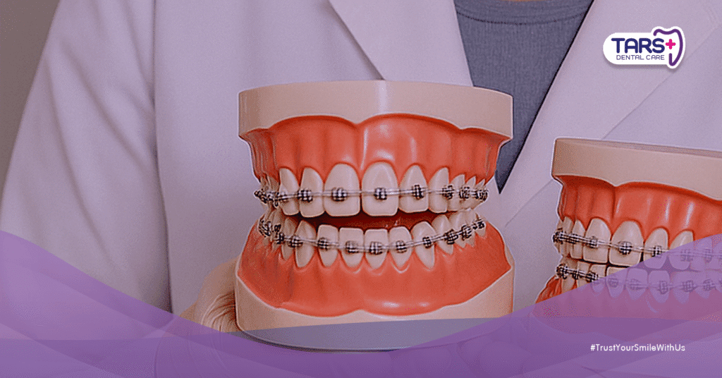 Behel Murah di Bawah 3 Juta, Tapi Gigi Jadi Miring Semua