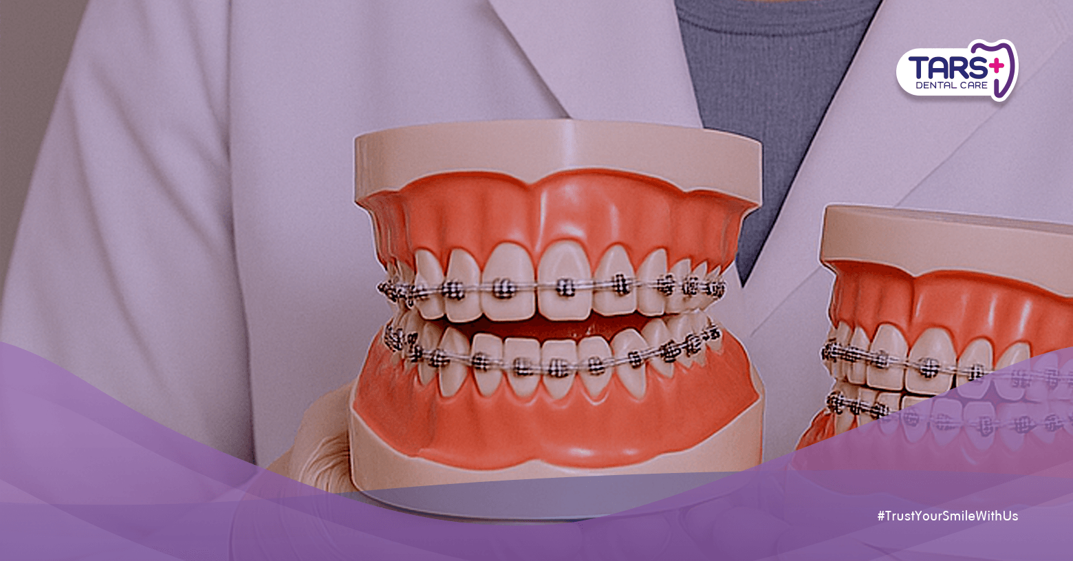 Behel Murah di Bawah 3 Juta, Tapi Gigi Jadi Miring Semua