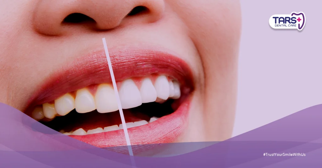 Gigi Kuning Padahal Sikat Gigi? Ini 5 Fakta Penting yang Harus Kamu Tahu