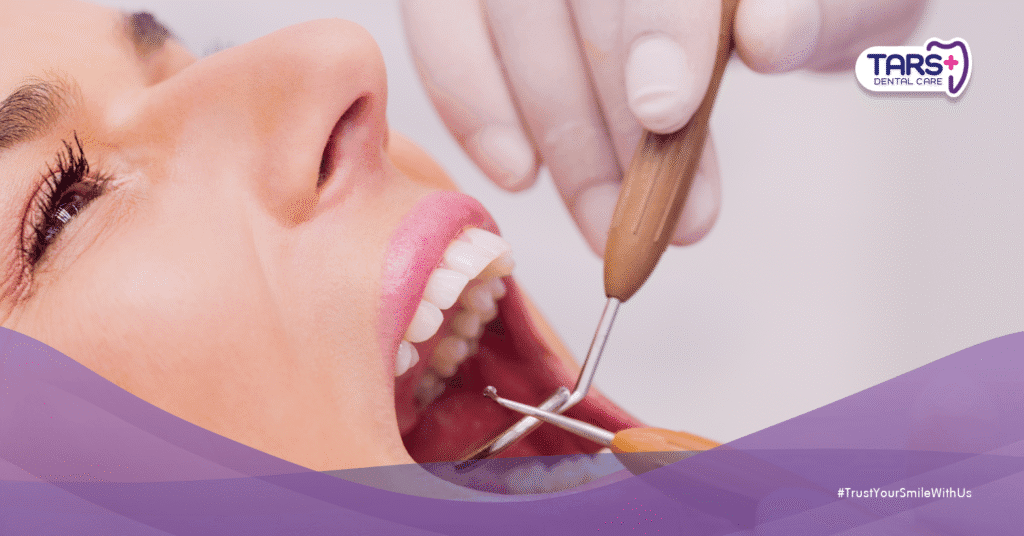 Mengapa Scaling Gigi Penting? Ini 5 Alasannya yang Wajib Kamu Tahu