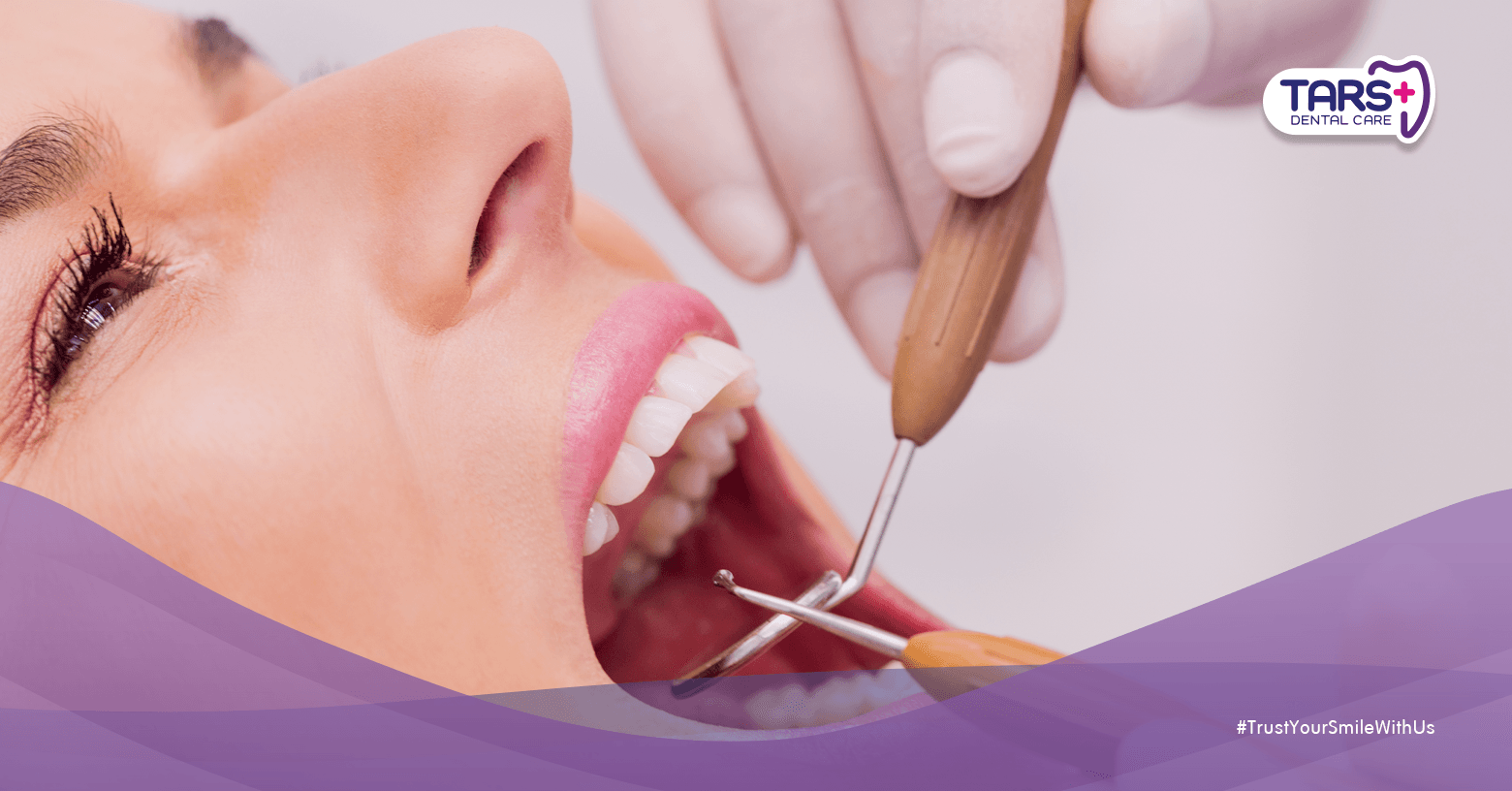 Mengapa Scaling Gigi Penting? Ini 5 Alasannya yang Wajib Kamu Tahu