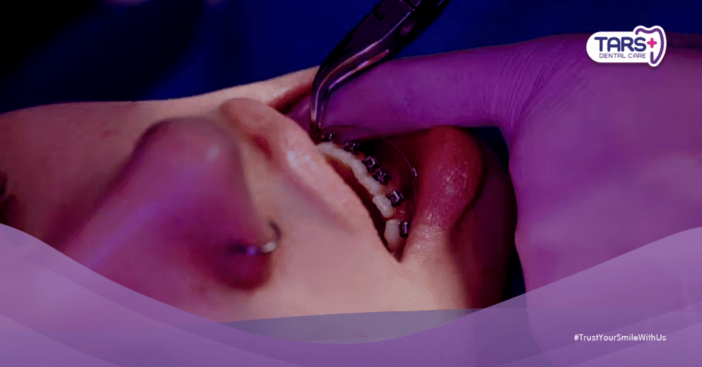 5 Bahaya Seram Pasang Behel di Tempat Salah: Gigi Hancur, Rahang Miring, Duit Hilang!