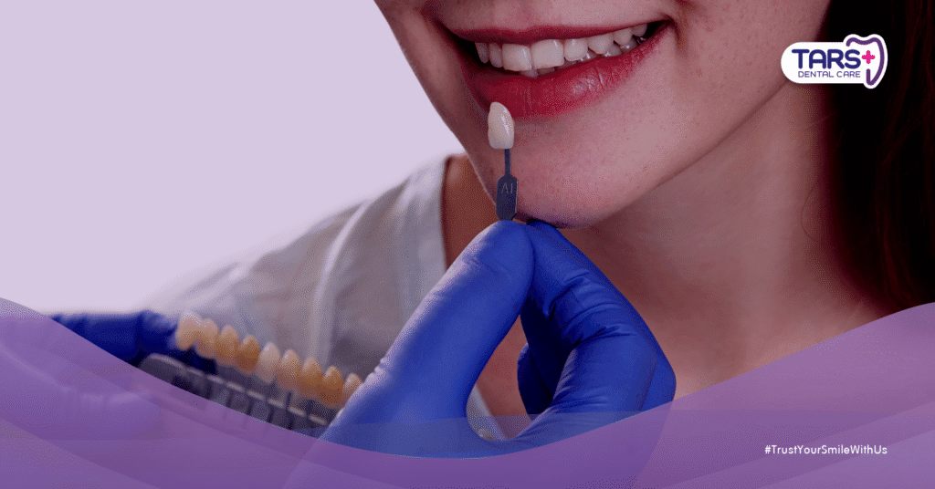 Veneer Gigi Bisa Rusak Gigi Asli? Fakta atau Mitos?