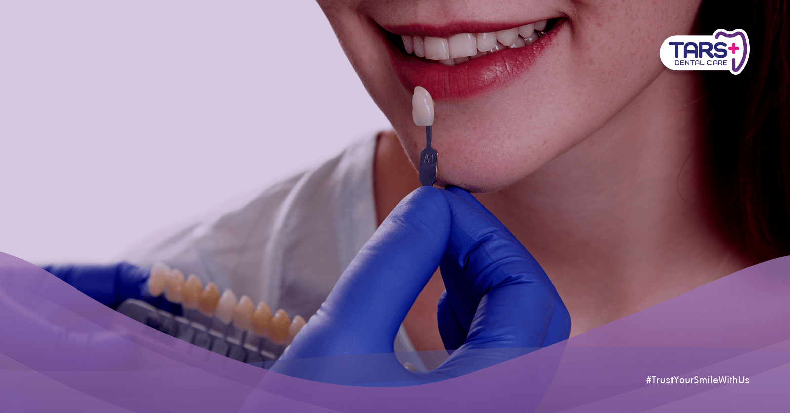 Veneer Gigi Bisa Rusak Gigi Asli? Fakta atau Mitos?