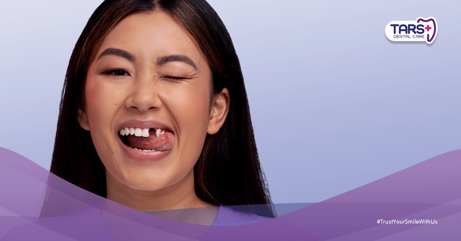 Apakah Cabut Gigi Selalu Butuh Gigi Pengganti? 7 Fakta Penting yang Perlu Kamu Tahu