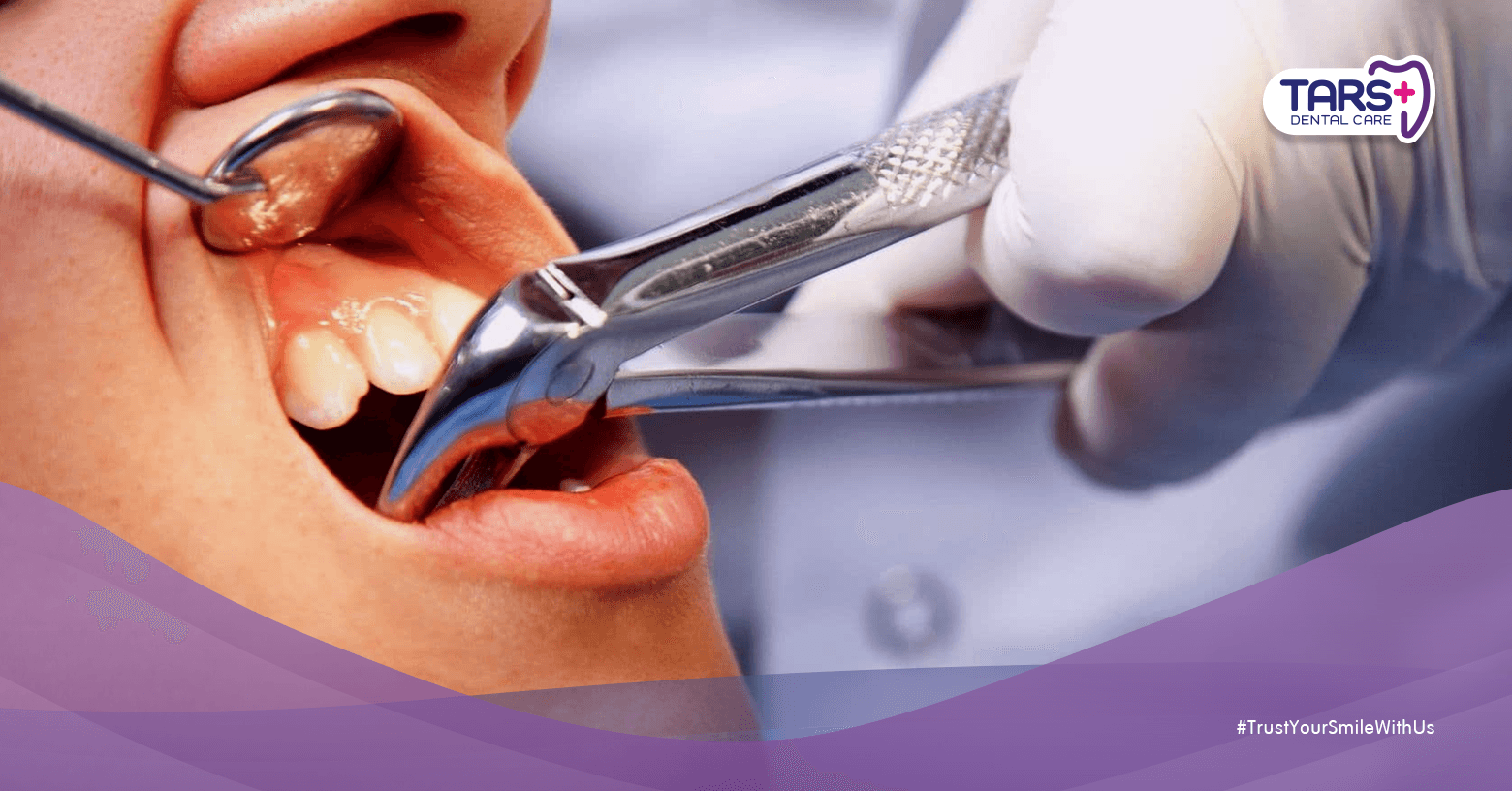 Gigi Bisa Tumbuh Lagi Setelah Dicabut? Fakta Lengkap dan Solusi