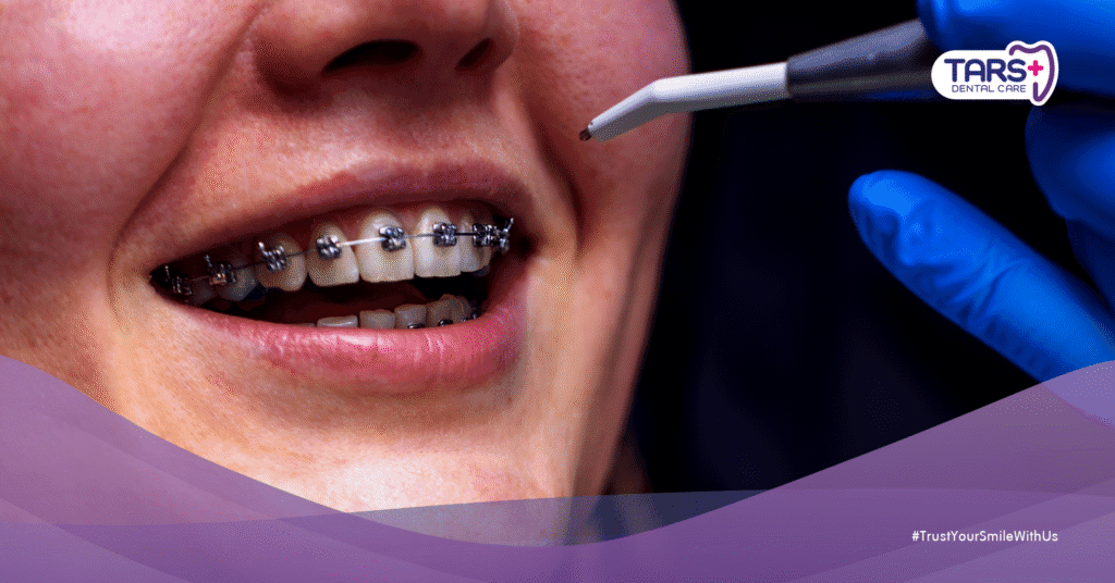 Gigi Dewasa Bisa Rapi Tanpa Behel? Ini 7 Fakta Mengejutkan