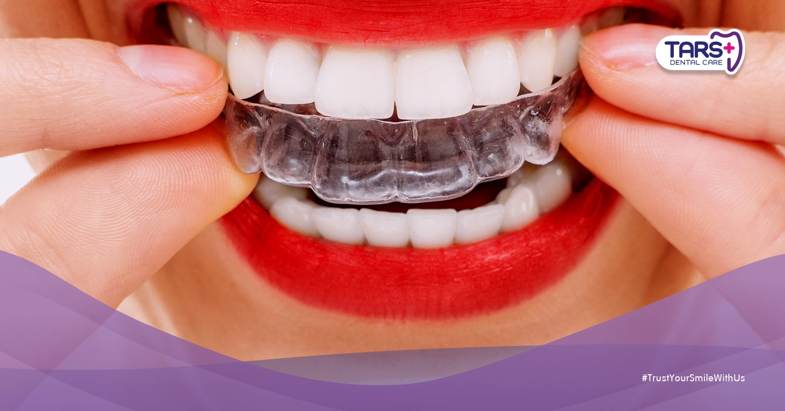 Retainer: 7 Fakta Penting yang Harus Kamu Tahu Setelah Behel Dilepas