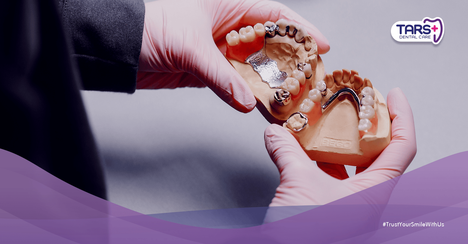 5 Fakta tentang Gigi Palsu: Apakah Benar Bisa Bertahan Seumur Hidup?