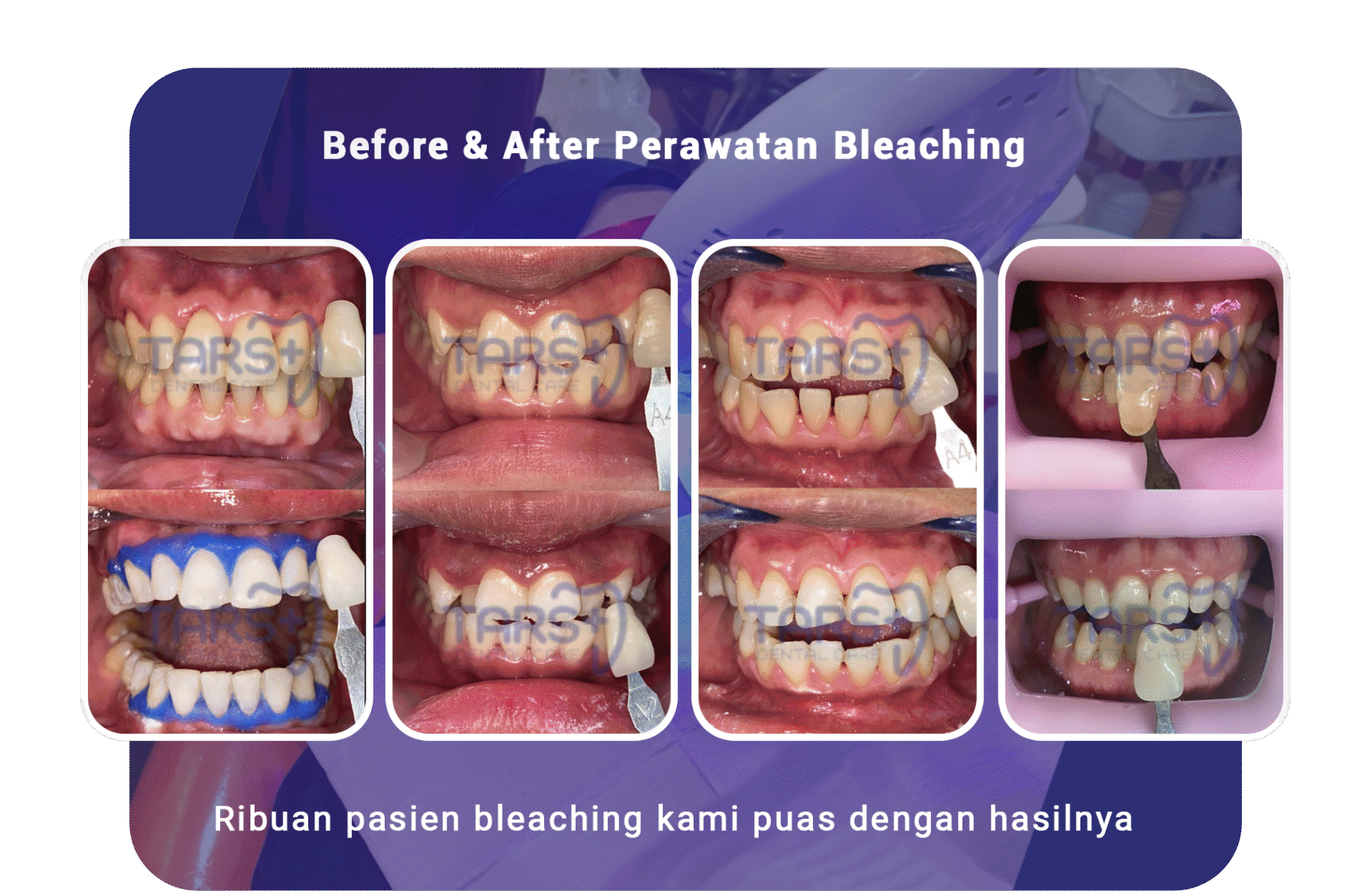 promo bleaching tars dental care agustus 2025