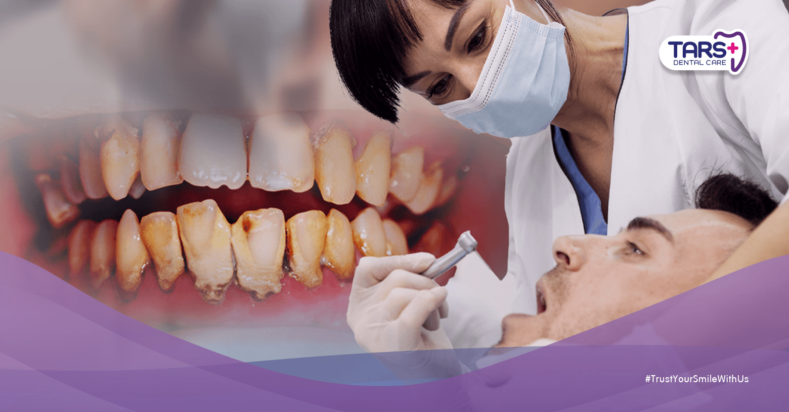 Bedanya Karang Gigi dan Noda Gigi yang Sering Disangka Sama