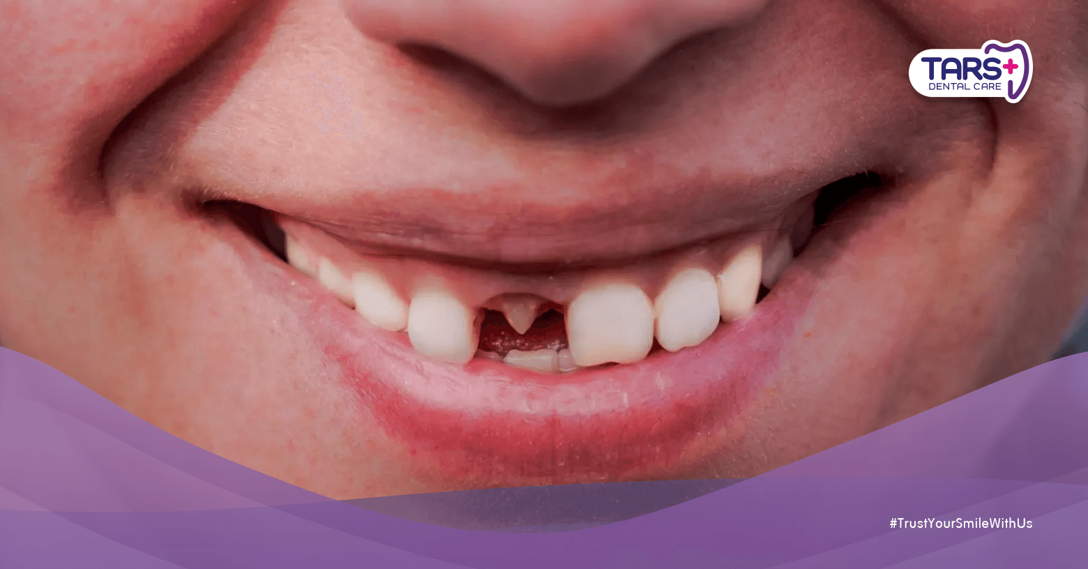 Pernah Dengar Gigi Tumbuh Lagi Setelah Dicabut? Ini Faktanya