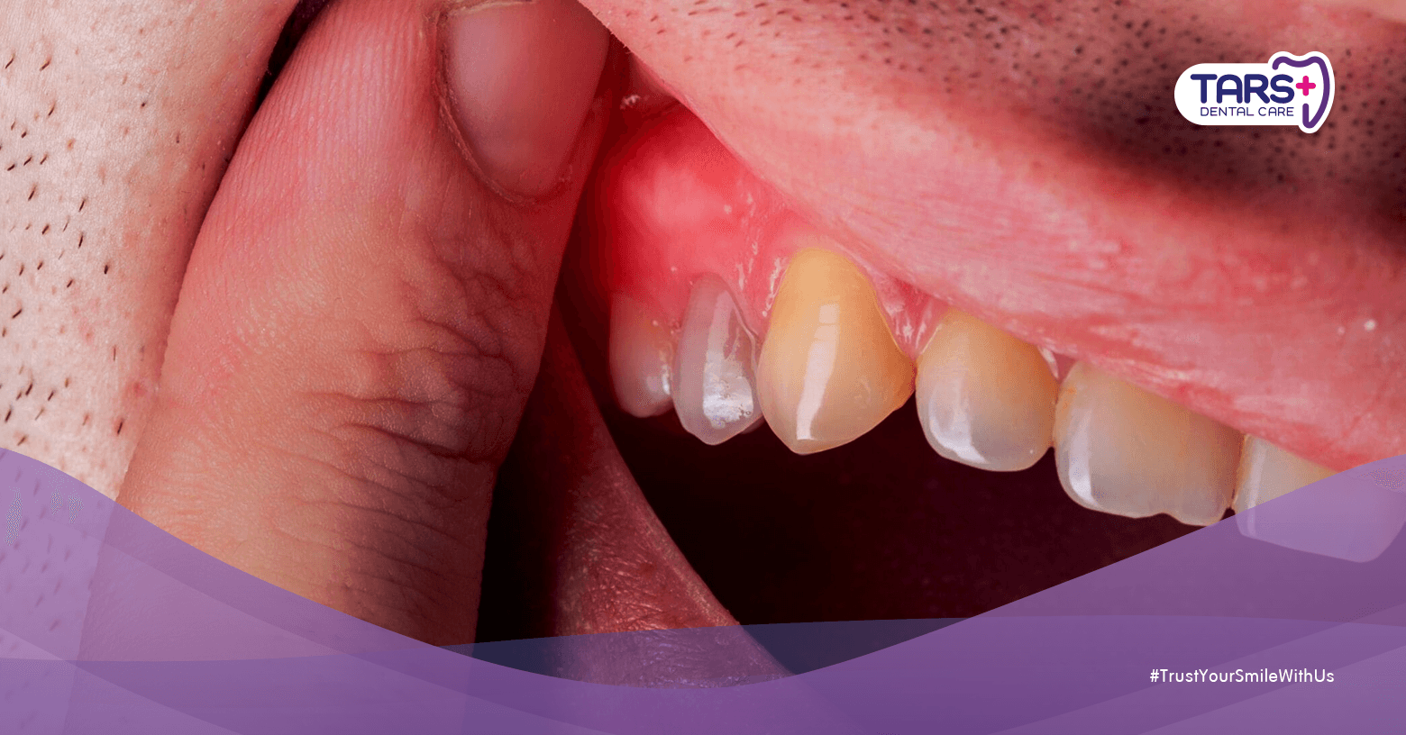 Gusi Bengkak Setelah Tahun Baru, Normal?