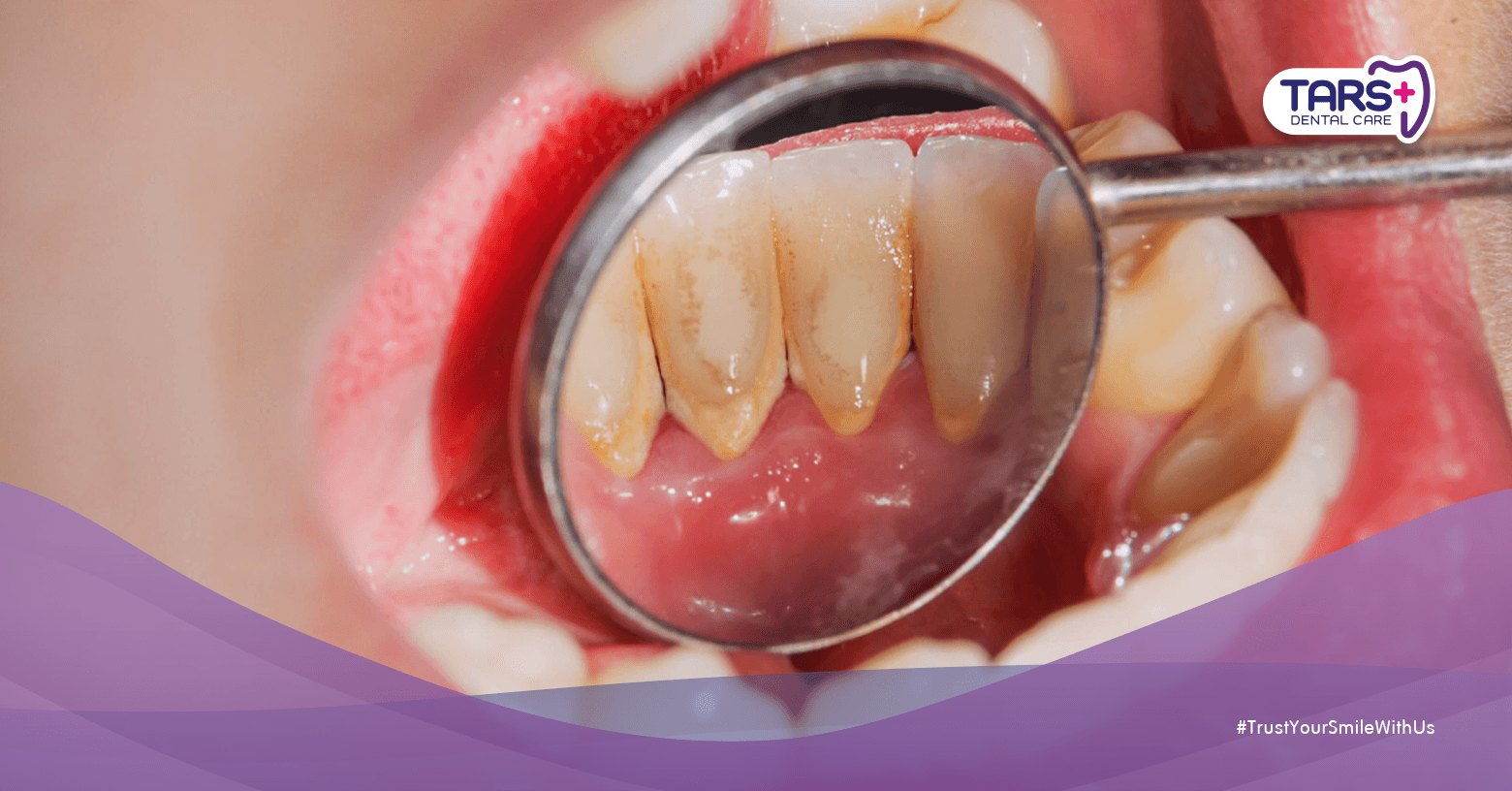 Karang Gigi: 5 Fakta Penting tentang Proses Terbentuknya