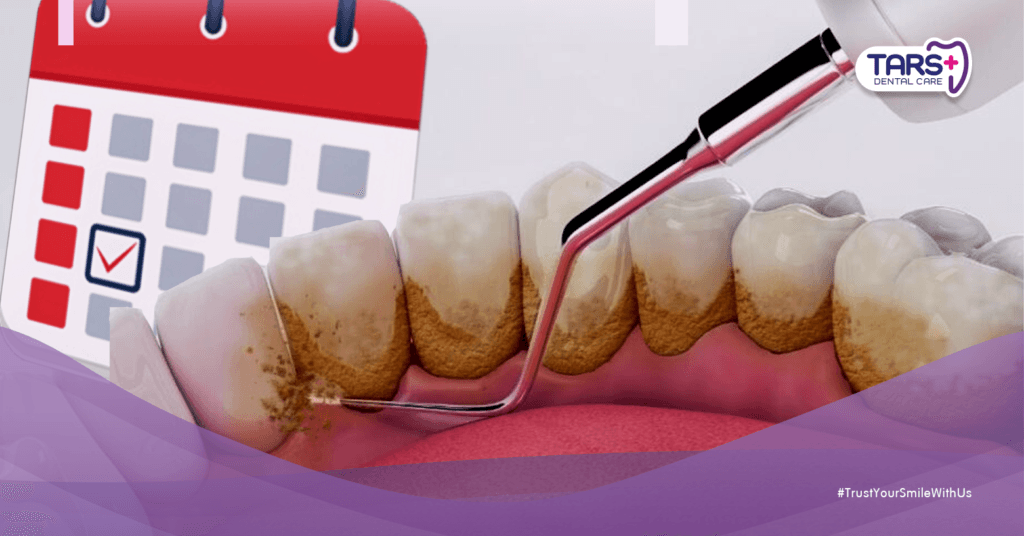 Bersihkan Karang Gigi: Kenapa Awal Tahun Waktu Terbaik untuk Scaling Gigi
